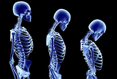 princ_rm_photo_of_stages_of_osteoporosis